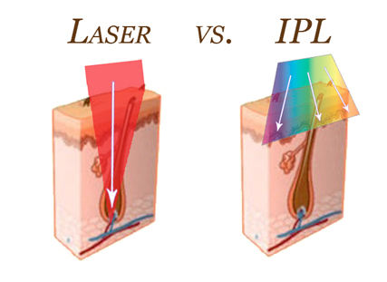 Diferencia entre ipl y laser sale