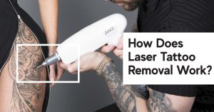 how does tattoo removal work
