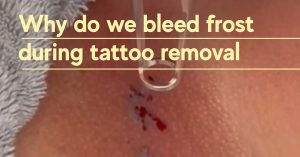 문신을 제거하는 동안 왜 성에가 피를 흘리나요?