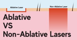Ablative lasers vs Non-Ablative Lasers
